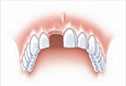 个别牙缺失