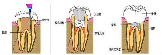 根管治疗步骤有哪些