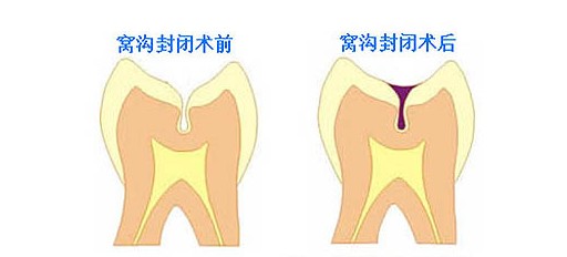 儿童几岁做窝沟封闭会比较好呢