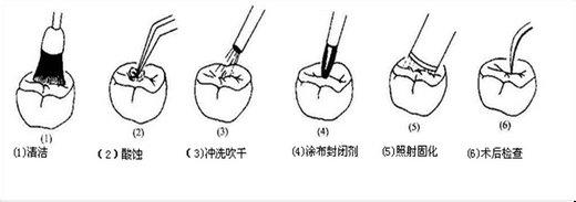 孩子窝沟封闭可以预防龋齿吗