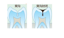 儿童窝沟封闭