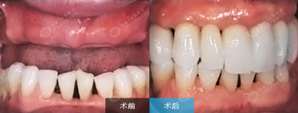 牙齿掉光了怎么办