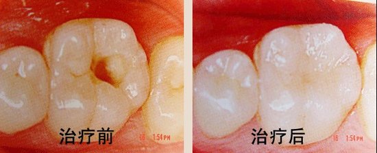 补牙到底会不会疼