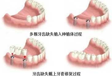 多颗牙缺失种植牙的费用是多少呢