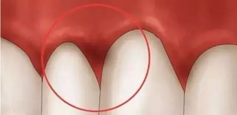 牙床肿痛怎么快速消肿