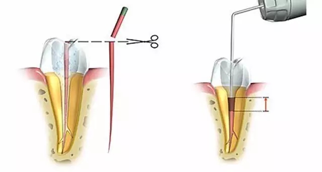 根管治疗的危害