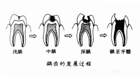 龋齿是什么意思