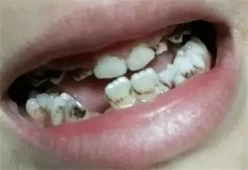 牙齿上有黑色的东西洗不掉怎么办